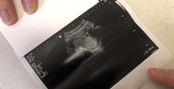The Science Changed: How the Technology of 3D Ultrasound Radically Transformed Abortion Debate