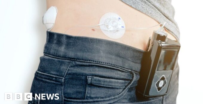 Diabetes artificial pancreas tech recommended for thousands on NHS